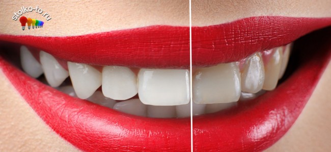 Сколько стоит отбелить зубы